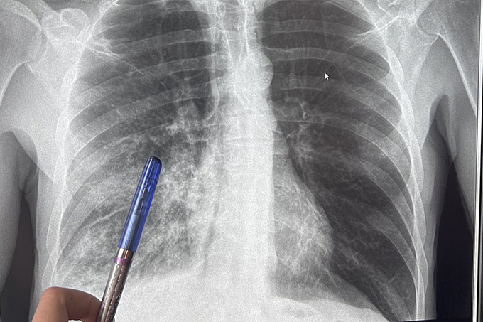 В чём важность проведения Дня борьбы с пневмонией